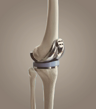膝關(guān)節(jié)置換